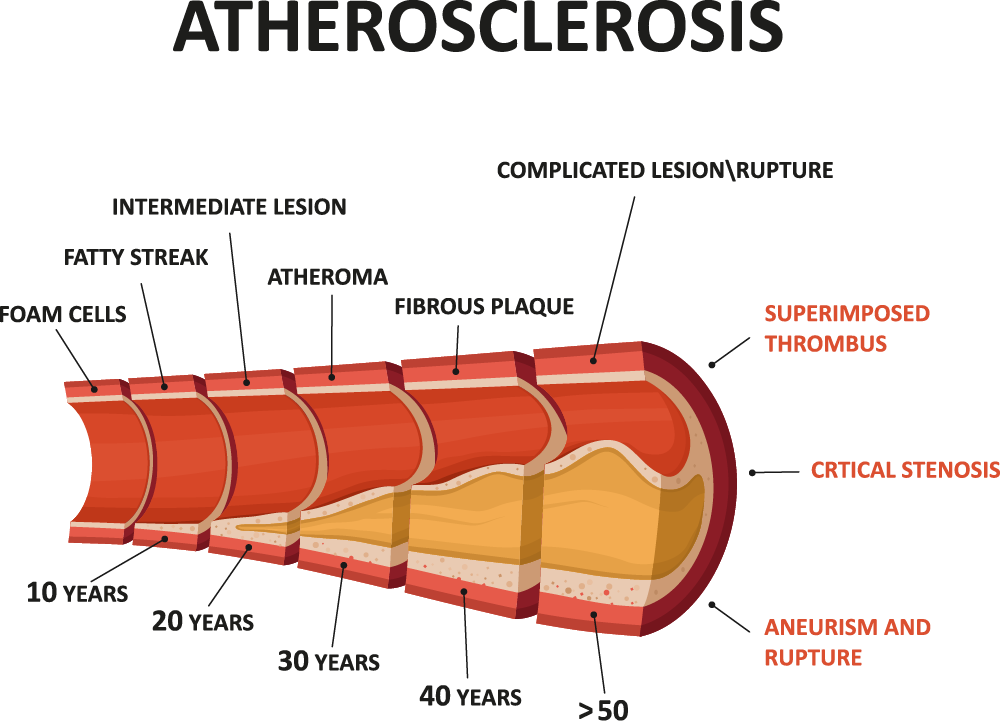 arteriosclerosis